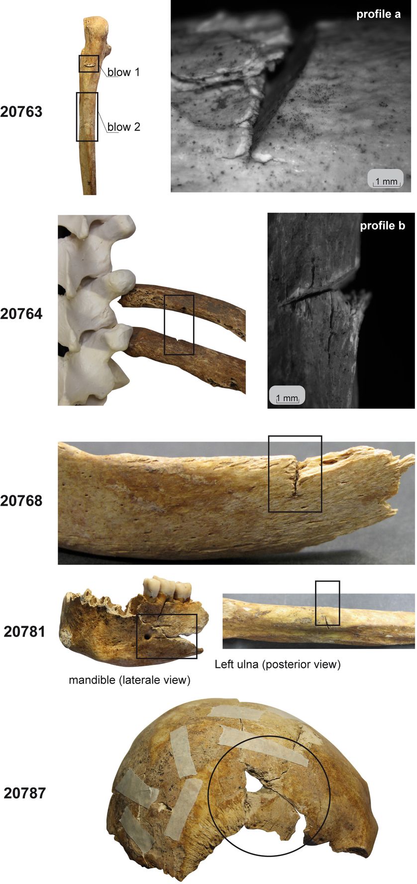 Lésions et données paléopathologiques observées sur les sujets de la sépulture 337 (Clichés macroscopiques et par macroscopie à épifluorescence en noir et blanc).